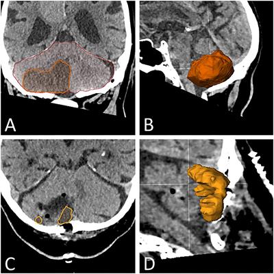 Clinical and Computerized Volumetric Analysis of Posterior Fossa Decompression for Space-Occupying Cerebellar Infarction